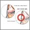 Lateral collateral ligament pain