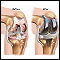 Knee joint replacement prosthesis